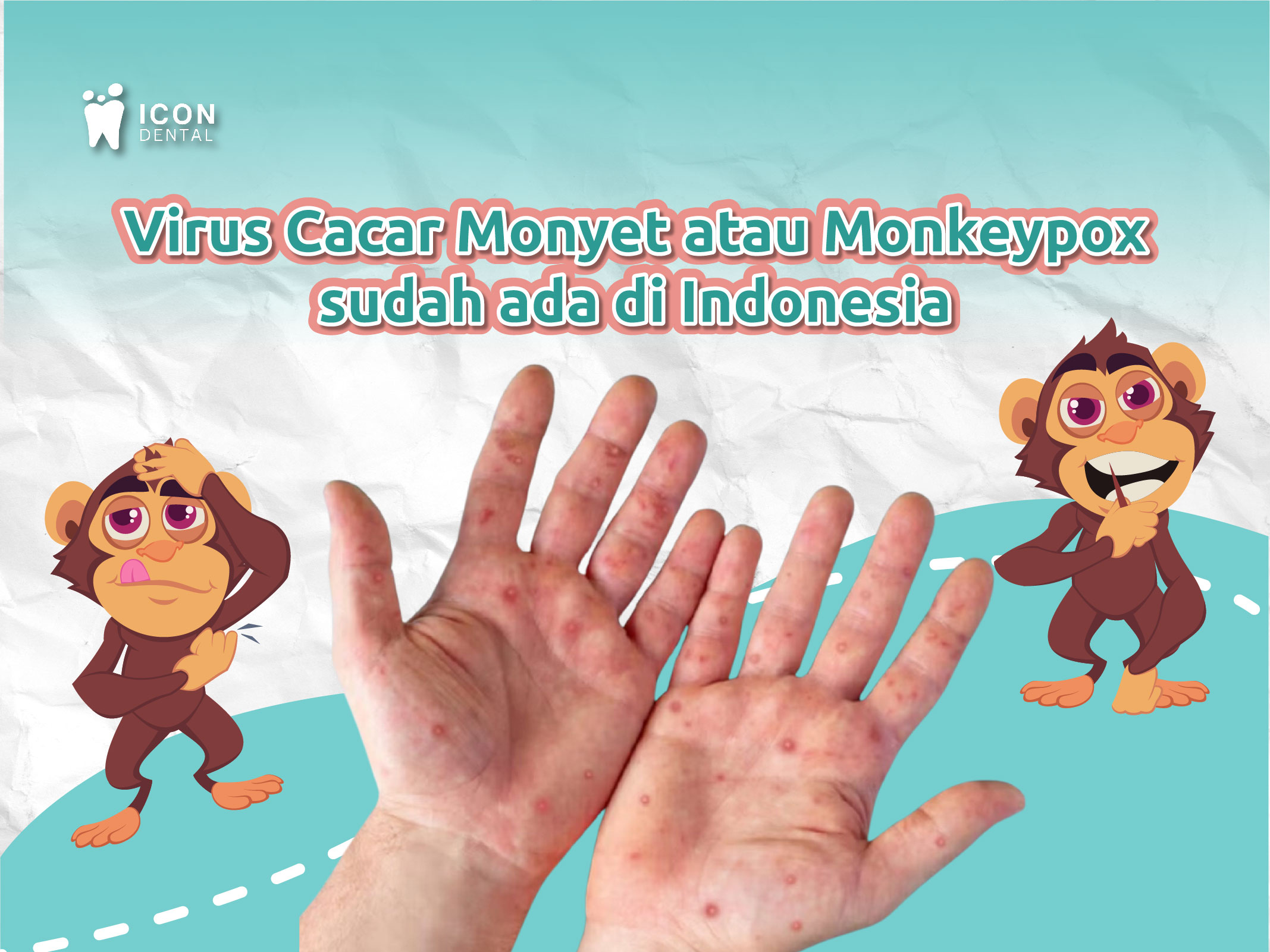 Monkey Pox sudah di Indonesia